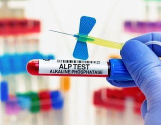 Alkaline Phosphatase (ALP) Alkaline Phosphatase (ALP)