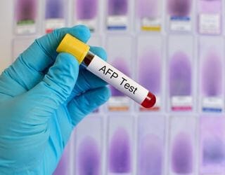 Alpha-Fetoprotein (AFP) Alpha-Fetoprotein (AFP)