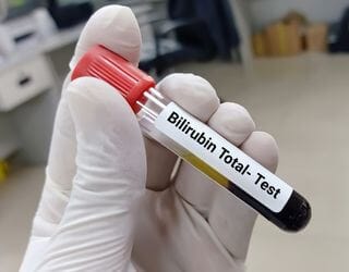 Bilirubin, Total, Direct & Indirect Bilirubin, Total, Direct & Indirect