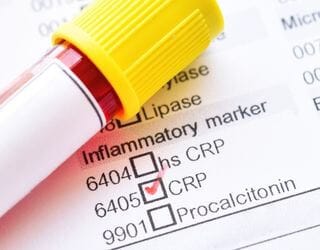 C-Reactive Protein (CRP) C-Reactive Protein (CRP)