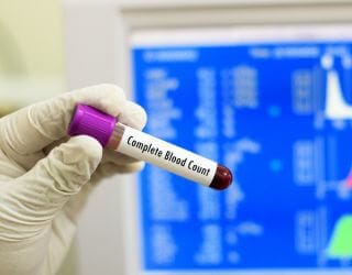 Complete Blood Count (CBC) Complete Blood Count (CBC)