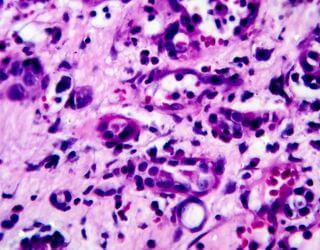 Histopathology, Biopsy Bone Histopathology, Biopsy Bone