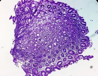 Histopathology, Biopsy Soft Tissue Histopathology, Biopsy Soft Tissue