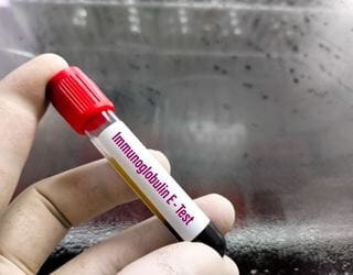 IgE Immunoglobulin, Serum IgE Immunoglobulin, Serum