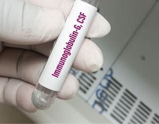 IgG Immunoglobulin, Serum IgG Immunoglobulin, Serum
