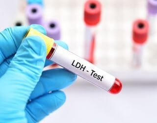 Lactic Dehydrogenase (LDH) Lactic Dehydrogenase (LDH)